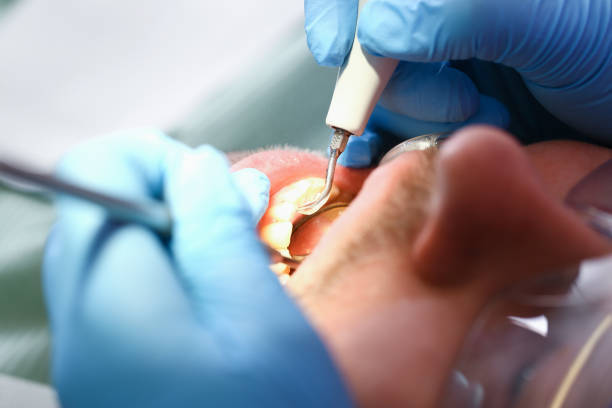 Best Emergency Tooth Extraction in Woodlawn, MD